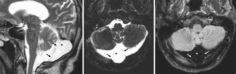 mega cisterna magna versus arachnoid cyst|Retrocerebellar arachnoid cyst .